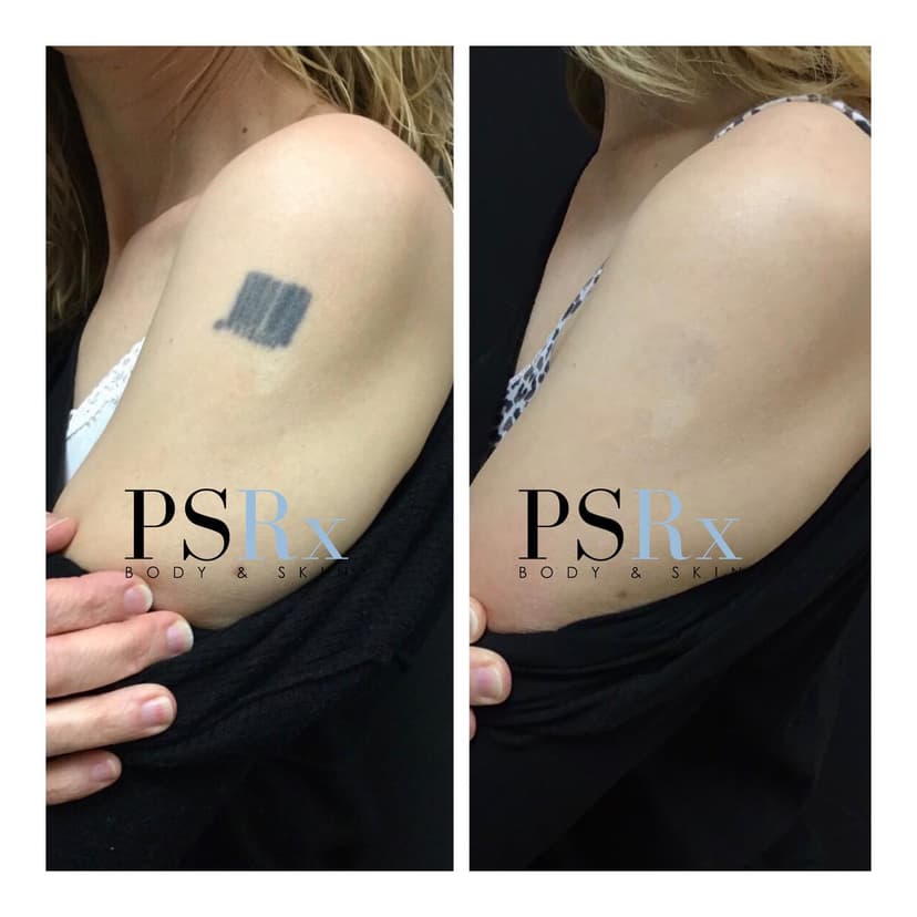Clinical skin treatment at PSRx