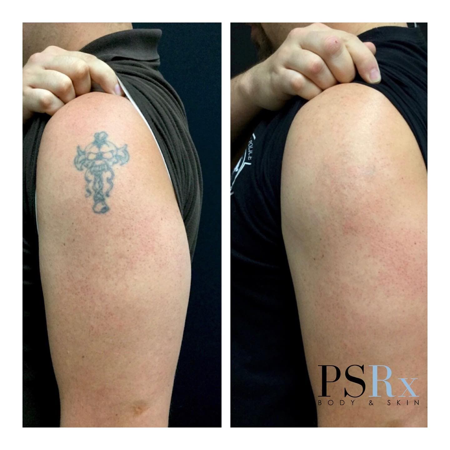 PSRx tattoo removal before and after