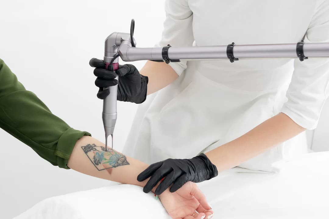 Tattoo removal laser treatment