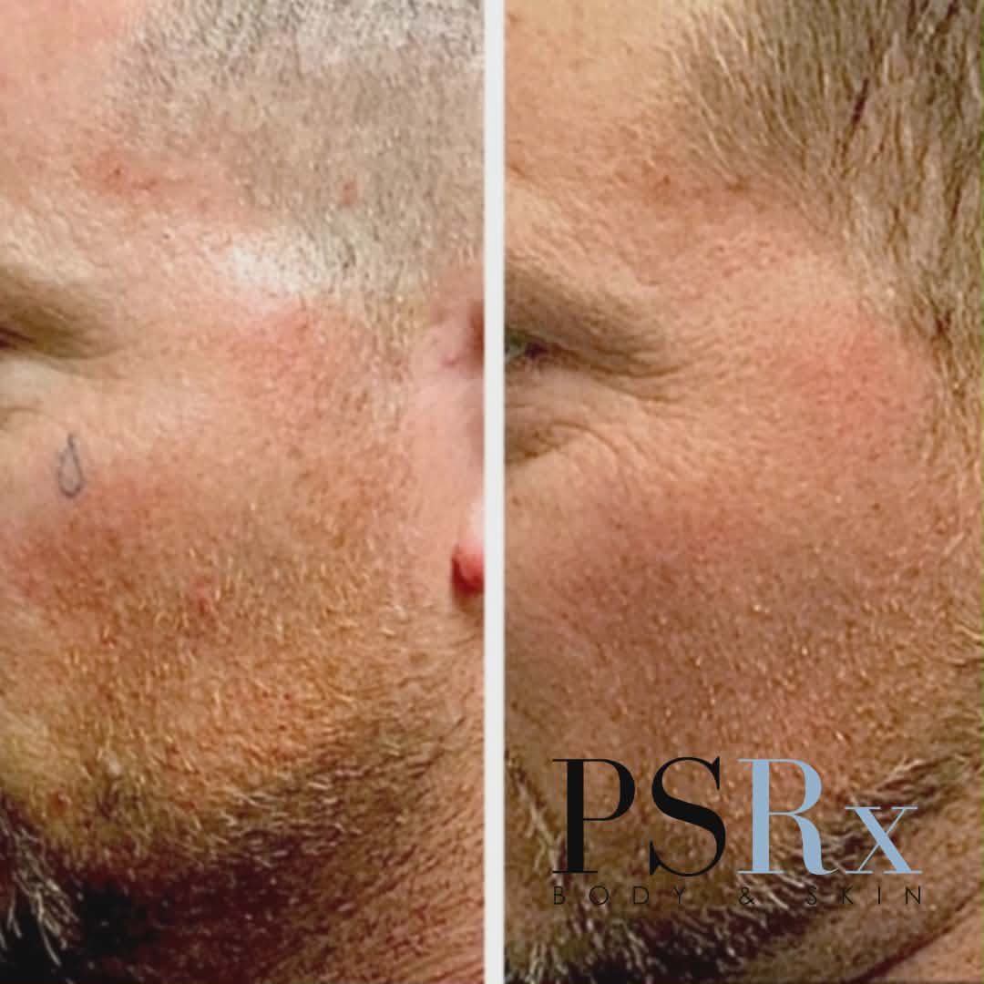 Tattoo removal journey